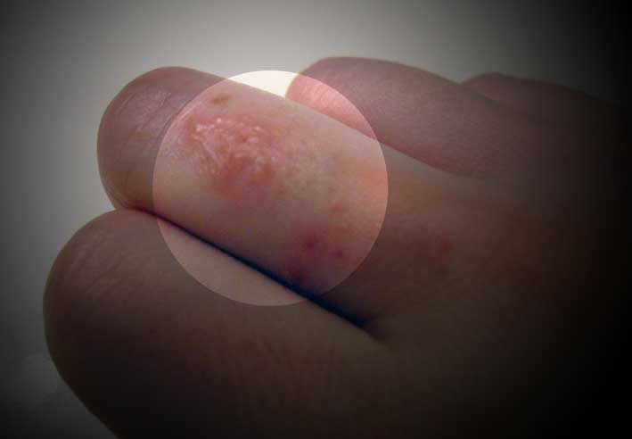 Dermatite da anello