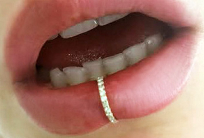 L’anello al labbro (non un piercing)
